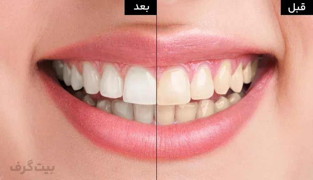 نتیجه ترفند سفید کردن دندان در فتوشاپ
